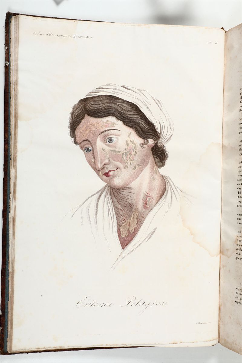 Alibert, Jean Louisclinica del Parigino Spedale di San Luigi Ossia Trattato Completo delle Malatt...