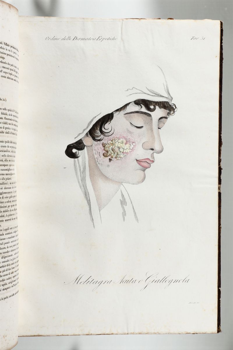 Alibert, Jean Louisclinica del Parigino Spedale di San Luigi Ossia Trattato Completo delle Malatt...